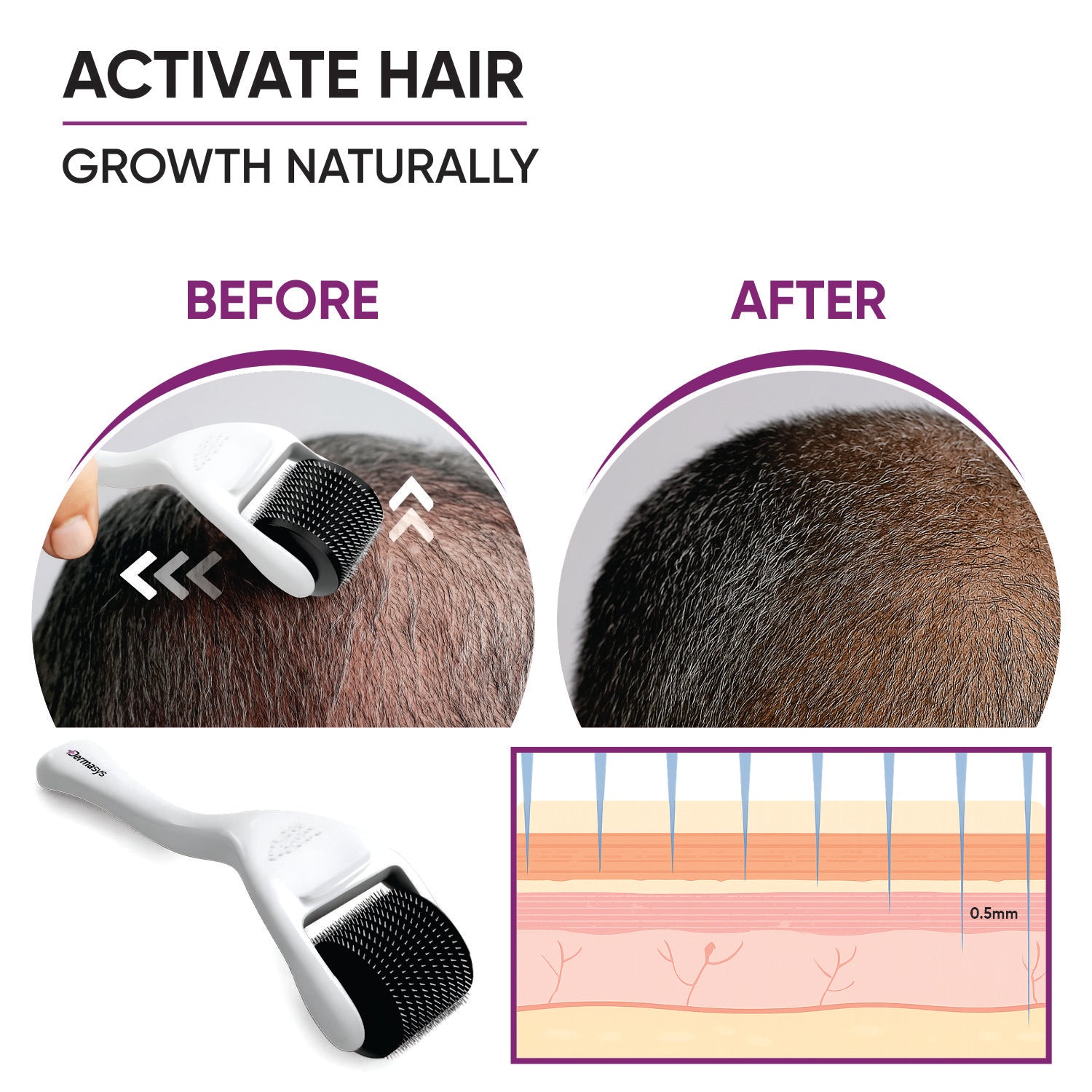 Derma roller 0.5mm for beard growth and patchy beard improvement